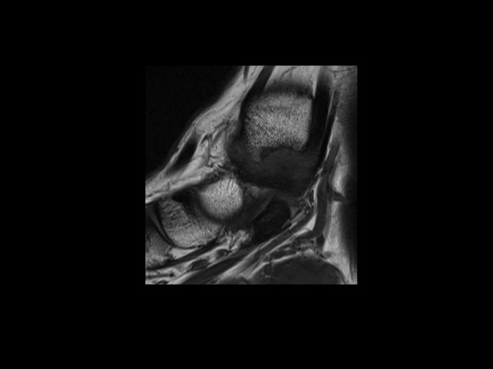 Figure 3 for case anteromedial ankle impingement